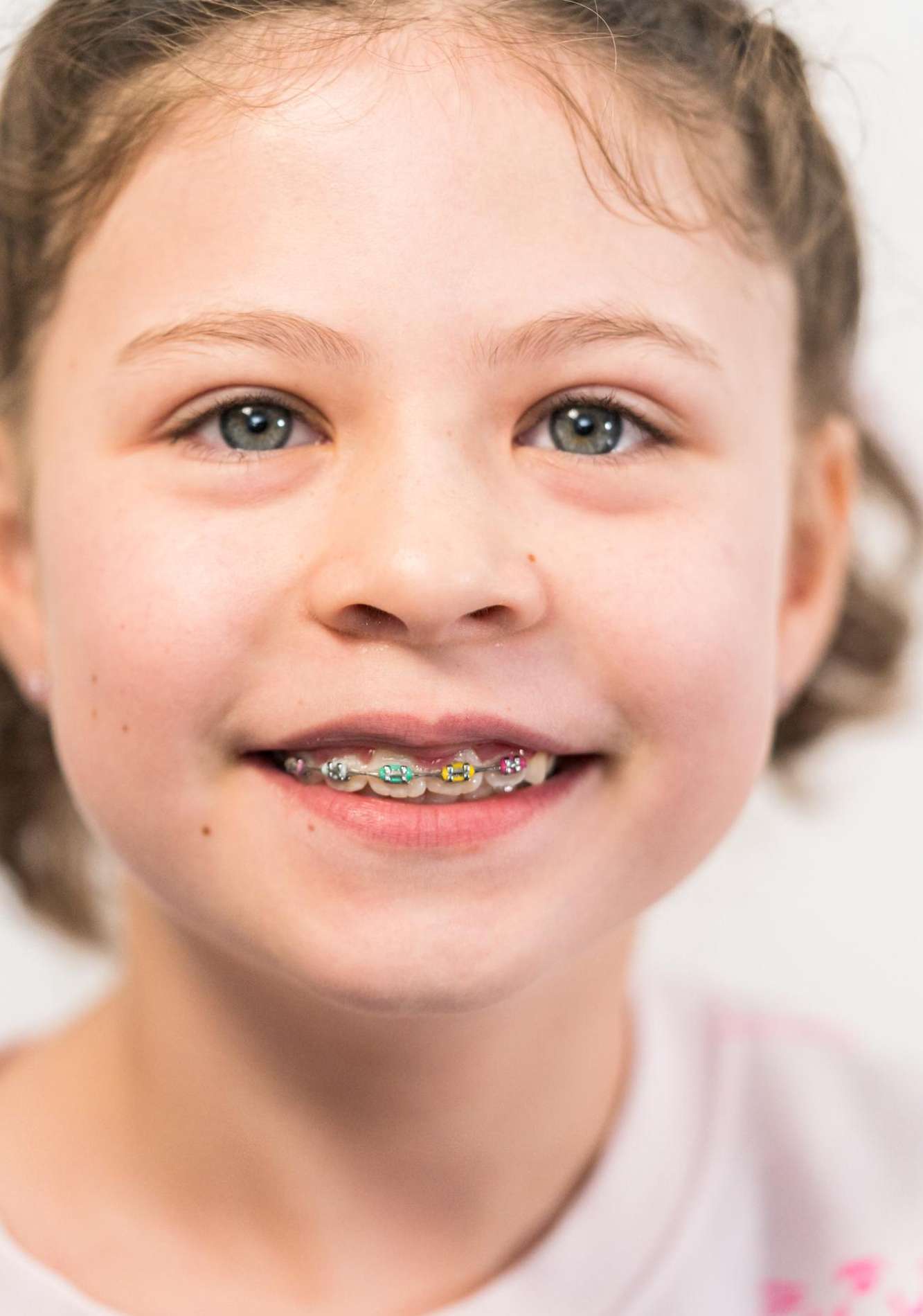 Benefits of early orthodontic treatment