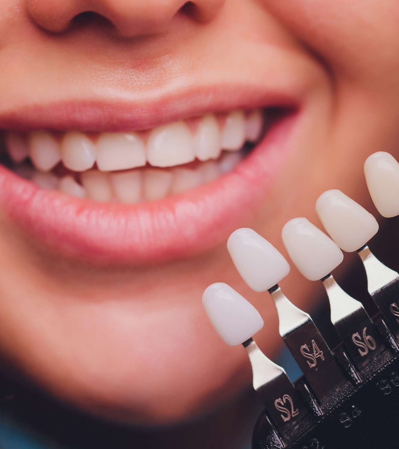 Veneers