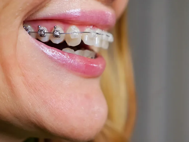 Clarity ceramic braces