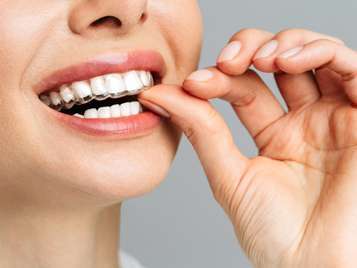 Invisalign treatment