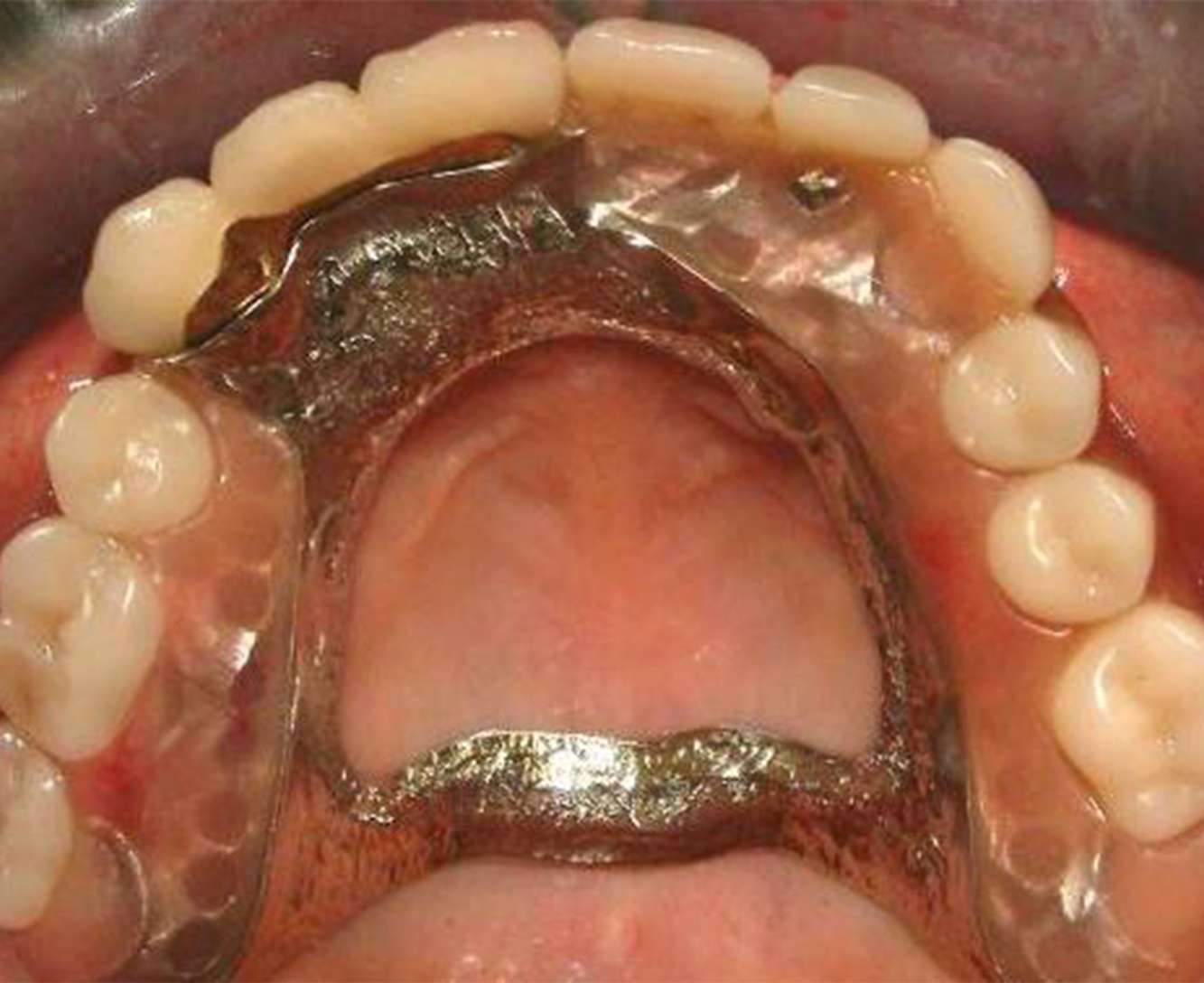 Removable partial dentures