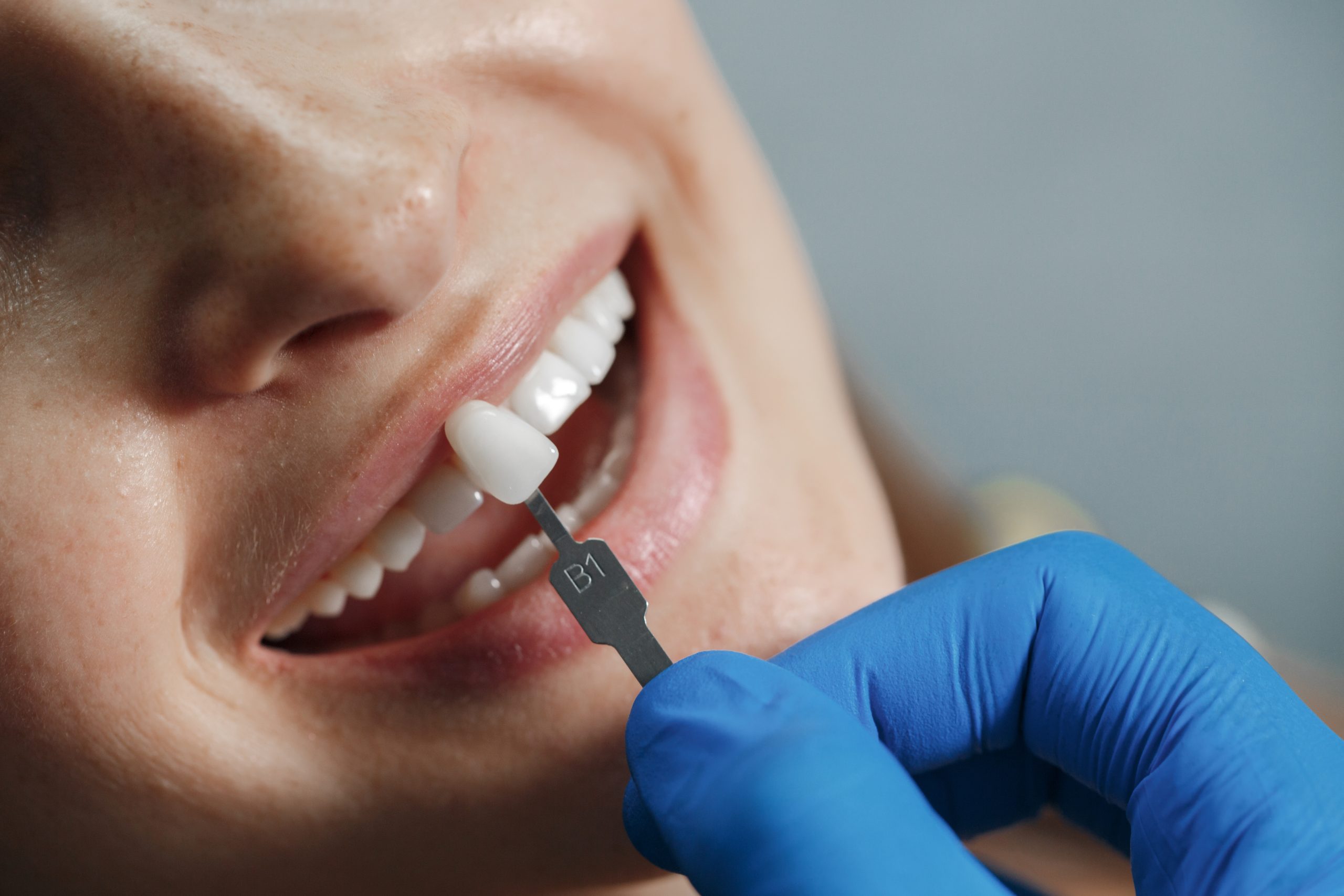 Single Tooth Implant in Turramurra