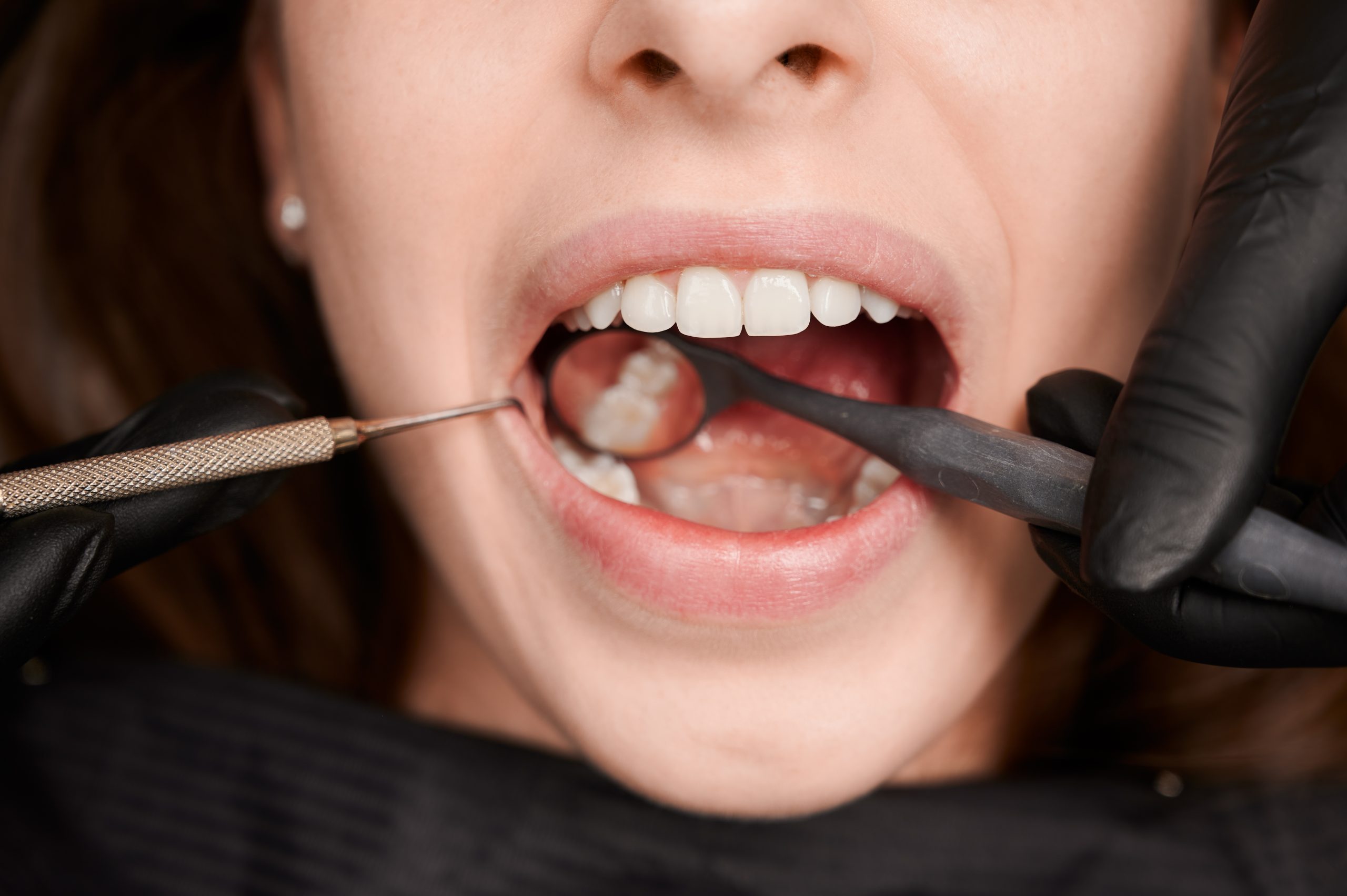 Gaps Between Teeth Treatment in Turramurra